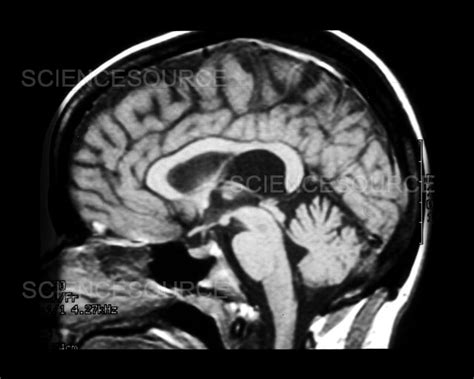 Mri Of Arachnoid Cyst Stock Image Science Source Images