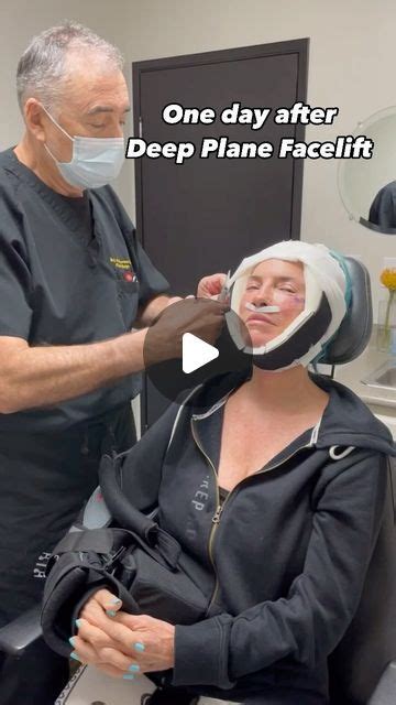 Boris M Ackerman Md On Instagram Facelift Bandages Come Off 1 Day