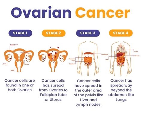 Ovarian Cancer Treatment