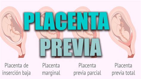 PLACENTA PREVIA en el embarazo placenta baja Qué es Cómo afecta al