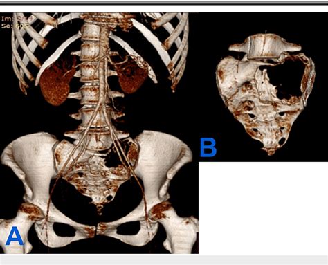 Figure 2 From A Case Report Of A Sacral Giant Cell Tumor Treated With Block Resection And Lumbo