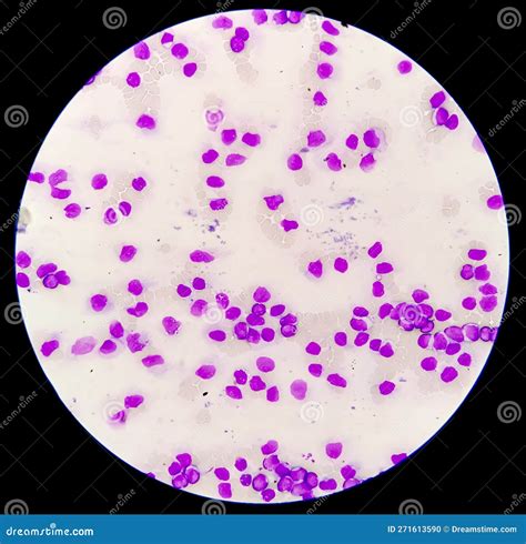 Acute Myeloid Leukemia Aml Smear Show Monocytes And Mostly Blast