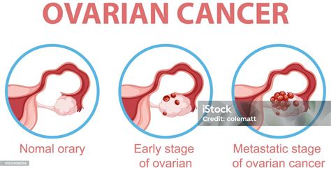 Infografis Proses Perkembangan Kanker Ovarium Ilustrasi Stok Unduh