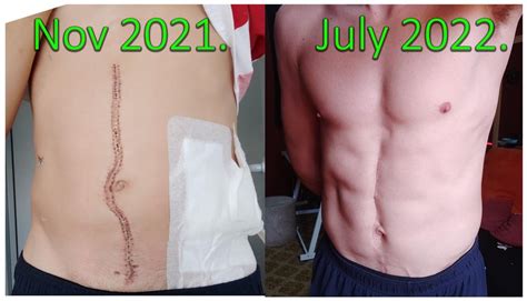 SPKT (kidney + pancreas transplant) scar progress : transplant