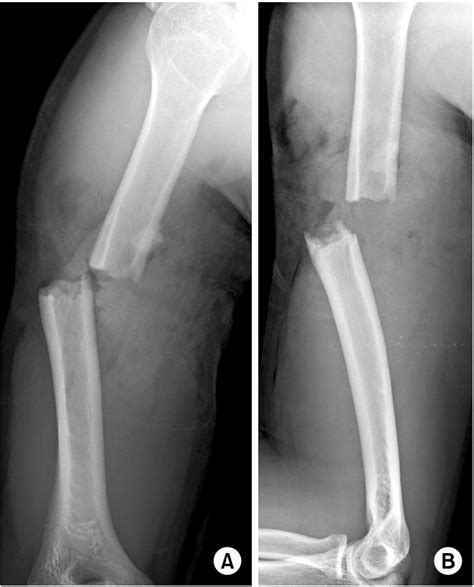 Initial Anteroposterior A And Lateral B Plain Radiographs Show