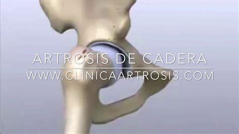 Artrosis De Cadera Coxartrosis Youtube