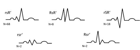 Rbbb Morphologies Lead V1 Rbbb Right Bundle Branch Block Download Scientific Diagram