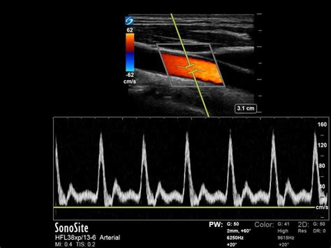 Sonography Doppler Flow Imaging Instrumentation Statpearls Ncbi Bookshelf