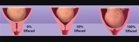 Cervical Effacement And Dilation Chart