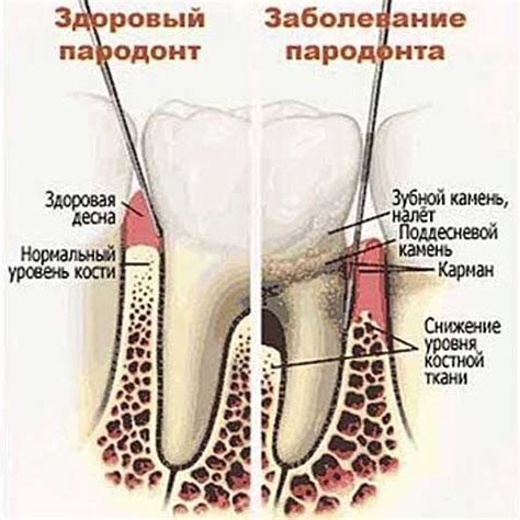 Ознаки захворювання ясен