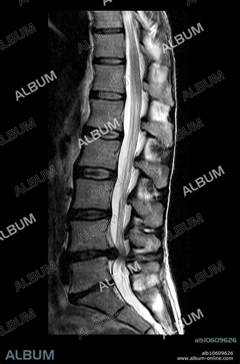 Large Lumbar Herniated Disc Album Alb