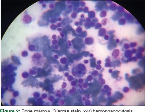 Figure From Hemophagocytic Syndrome Secondary To Plasmodium Vivax