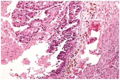 Clear Cell Carcinoma Arising Within An Endometriotic Cyst Typical Download Scientific Diagram