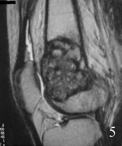 Giant Cell Tumor Of Bone Bone Tumors