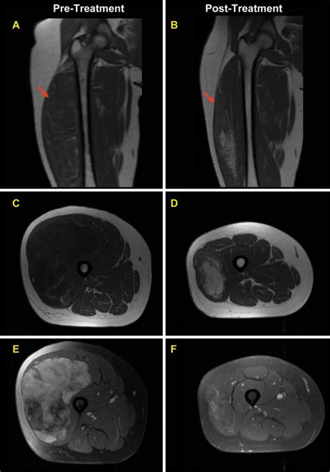 Mri Findings In A Case Of Myxoid Liposarcoma Which Developed Extensive