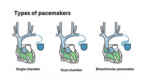 Pacemaker | What is a Pacemaker? | PortalCLÍNIC