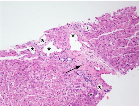 Figure From Mercaptopurine Induced Hepatoportal Sclerosis In A