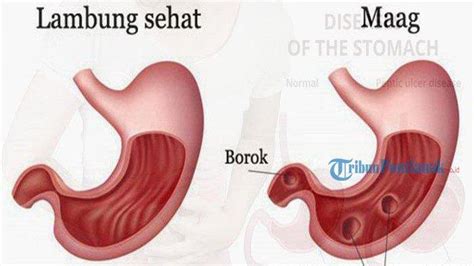 Risiko Penyakit Maag Pada Penderita Cek Bedanya Dengan Gejala Asam