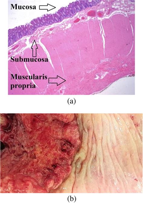 Colorectal Cancer Histology