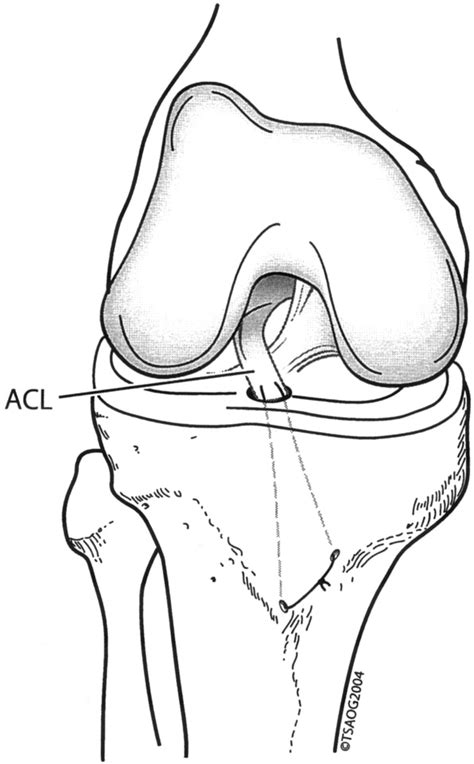 Part Ii Arthroscopic Treatment Of Tibial Plateau Fractures