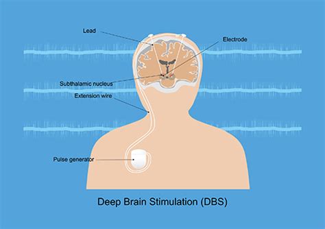 Deep Brain Stimulation Dbs Lee Health