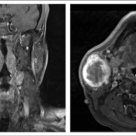 Coronal And Axial T Fat Suppressed Contrast Enhanced Mri Showing A