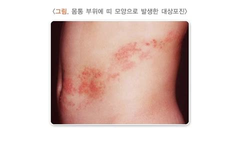 대상포진의 원인과 증상 치료법 정확히 알아보기