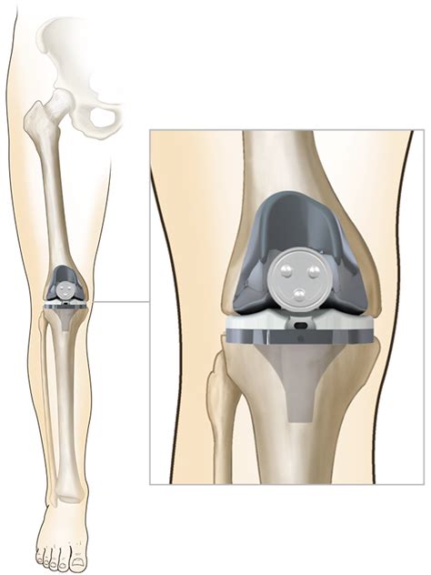 Total Knee Replacement