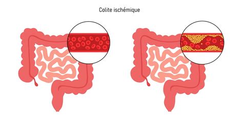 Ischemic Colitis: Signs, Causes, How To Treat?