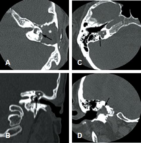 Cholesteatoma: Causes, Treatment, and Complications | Ento Key