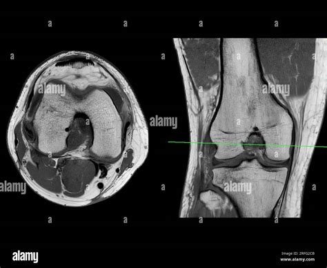 Imágenes por resonancia magnética o RM de la articulación de la rodilla