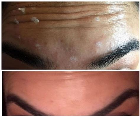 botox for forehead wrinkles photos (1) » Facial Injections: Info, Prices, Photos, Reviews, Q&A