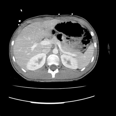 Filenormal Dual Phase Trauma Ct Chestabdomen And Pelvis Radiopaedia