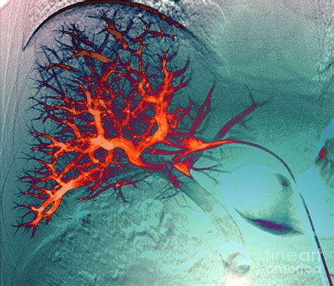 Liver Blood Vessels Photograph By Zephyr Science Photo Library Pixels