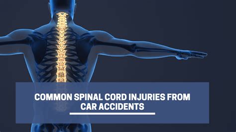 Common Spinal Cord Injuries From Car Accidents