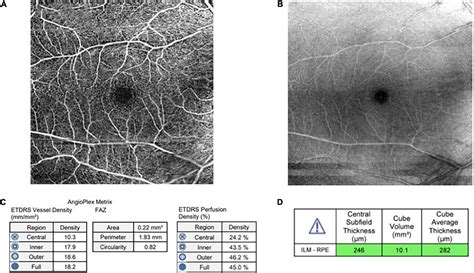 Frontiers Retinal Optical Coherence Tomography Angiography Parameters