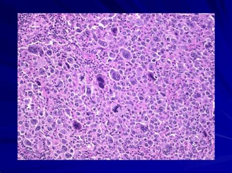 Finding cancerous anaplastic cells with image analysis