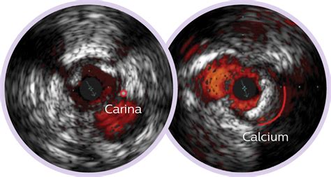 Coronary Ivus Intravascular Ultrasound Philips