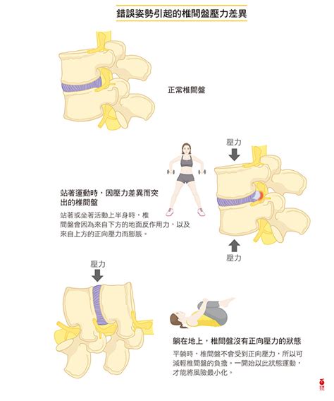 椎間盤突出？姿勢不良是原因之一 康健雜誌