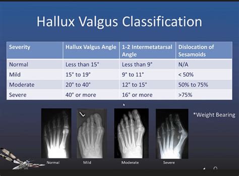 Hallux Valgus Angles Flashcards Quizlet