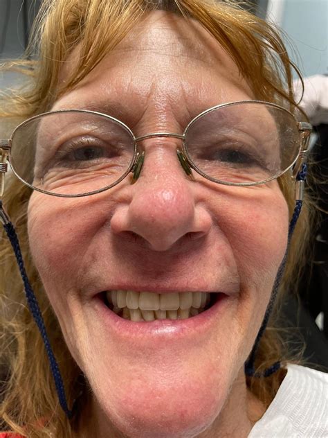 Smile Makeover With Dentures Carrollwood Village Dental
