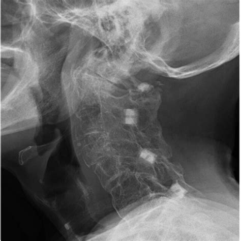 Lateral Radiograph Of Cervical Spine On Neutral Position Showed That