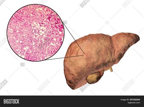 Fatty Liver, Liver Image & Photo (Free Trial) | Bigstock