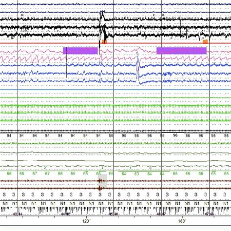 (PDF) Comparison between heart rate variability and pulse rate ...