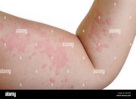 Rash Allergy Immagini E Fotografie Stock Ad Alta Risoluzione Alamy