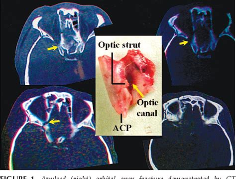 Figure 1 From Extradural Anterior Clinoidectomy As An Alternative Approach For Optic Nerve