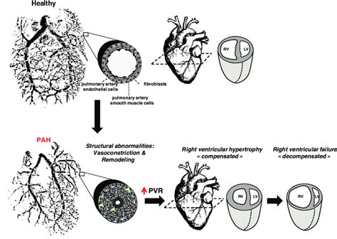 Schematic Representation Of Pah In An Advance Stage Of The Disease