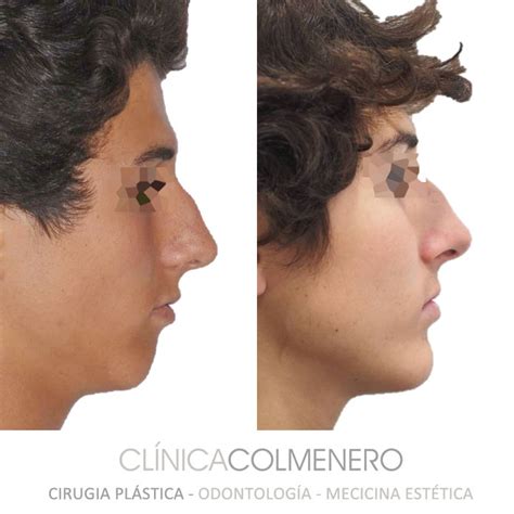 Mentoplastia Cl Nica Colmenero