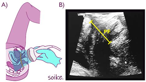 Diagnostics Free Full Text Ultrasonography Comparison Of Pelvic