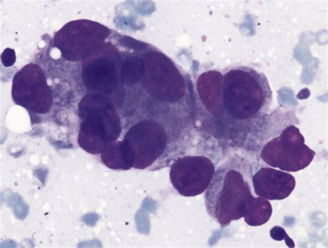 Fine‐needle Aspiration Cytology Of Large Cell Neuroendocrine Carcinoma